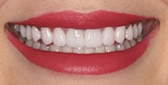 After Image: Case 332 - front