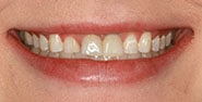 Before Image: Case 332 - front