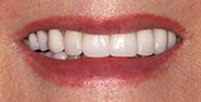 After Image: Case 334 - front