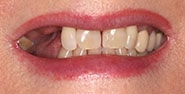 Before Image: Case 334 - front