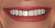 After Image: Case 335 - front