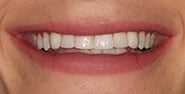 Before Image: Case 335 - front