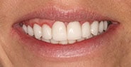 After Image: Case 336 - front