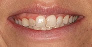 Before Image: Case 336 - front