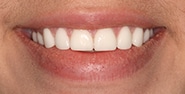 After Image: Case 337 - front