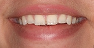 Before Image: Case 337 - front