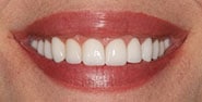 After Image: Case 338 - front
