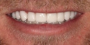 After Image: Case 339 - front