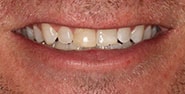 Before Image: Case 339 - front