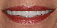 After Image: Case 34 - front