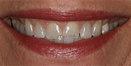 Before Image: Case 34 - front