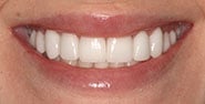 After Image: Case 340 - front