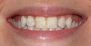 Before Image: Case 340 - front