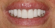 After Image: Case 341 - front