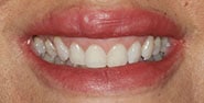 Before Image: Case 341 - front