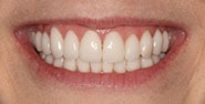 After Image: Case 342 - front