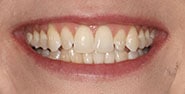 Before Image: Case 342 - front