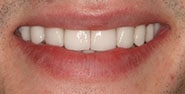 After Image: Case 343 - front