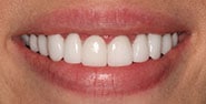 After Image: Case 344 - front