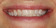 Before Image: Case 345 - front
