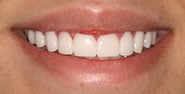 After Image: Case 346 - front