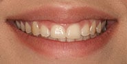 Before Image: Case 346 - front
