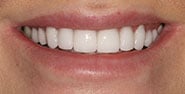 After Image: Case 348 - front