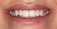 Before Image: Case 348 - front