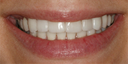 After Image: Case 35 - front