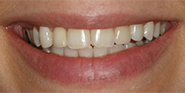 Before Image: Case 35 - front