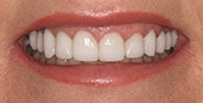 After Image: Case 350 - front