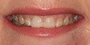 Before Image: Case 350 - front