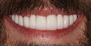 After Image: Case 351 - front