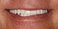 After Image: Case 352 - front