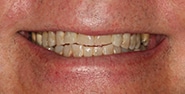 Before Image: Case 352 - front