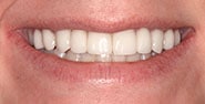 After Image: Case 353 - front