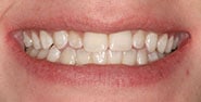 Before Image: Case 353 - front