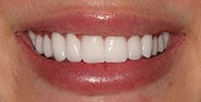 After Image: Case 354 - front
