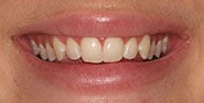 Before Image: Case 354 - front