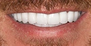 After Image: Case 357 - front