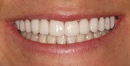 After Image: Case 358 - front