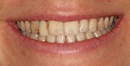 Before Image: Case 358 - front