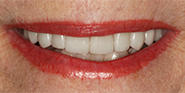 After Image: Case 36 - front