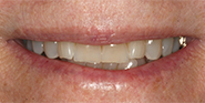 Before Image: Case 36 - front