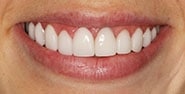 After Image: Case 361 - front