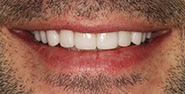 After Image: Case 362 - front