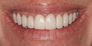 After Image: Case 363 - front