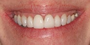Before Image: Case 363 - front