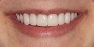 After Image: Case 364 - front