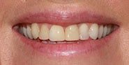 Before Image: Case 365 - front